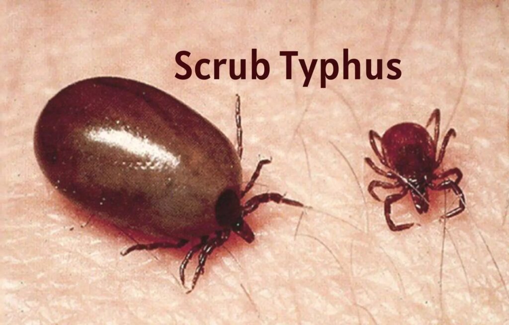 178326-scrub-typhus