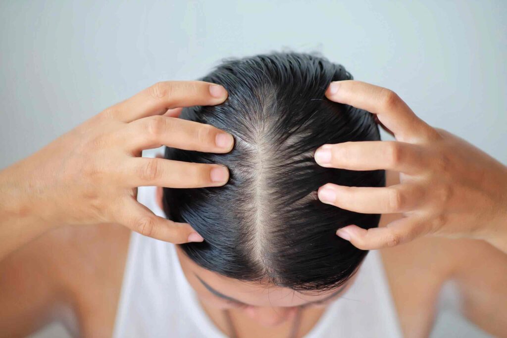 Hair-Loss-In-Women-Everything-You-Need-To-Know