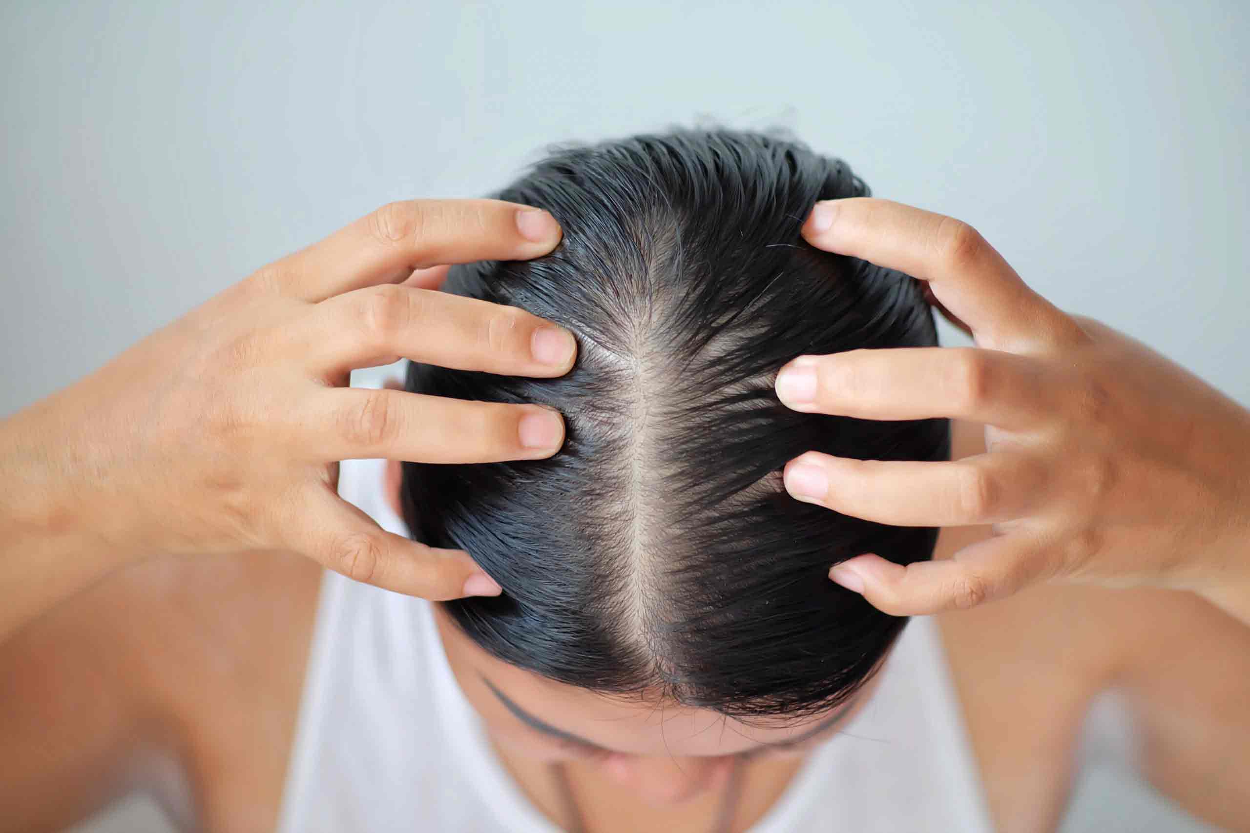 Hair-Loss-In-Women-Everything-You-Need-To-Know