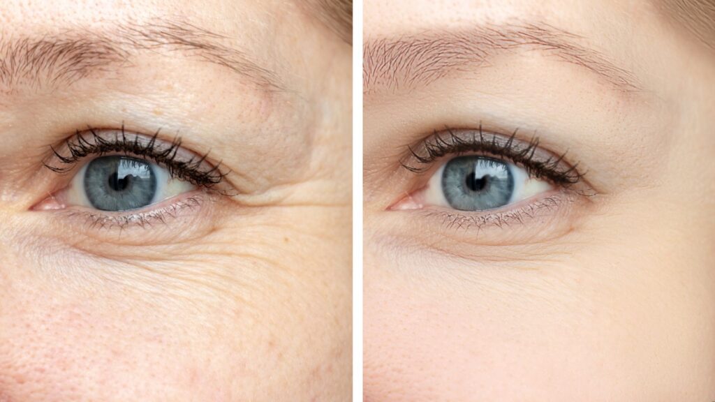 fine lines under eyes