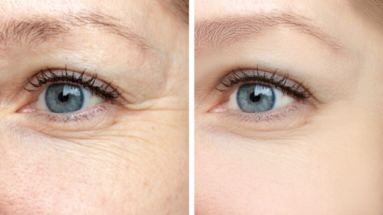 fine lines under eyes